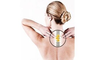 цервикална остеохондроза при жена