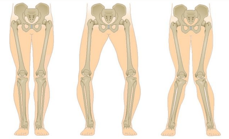 усложнения на артрозата на коляното